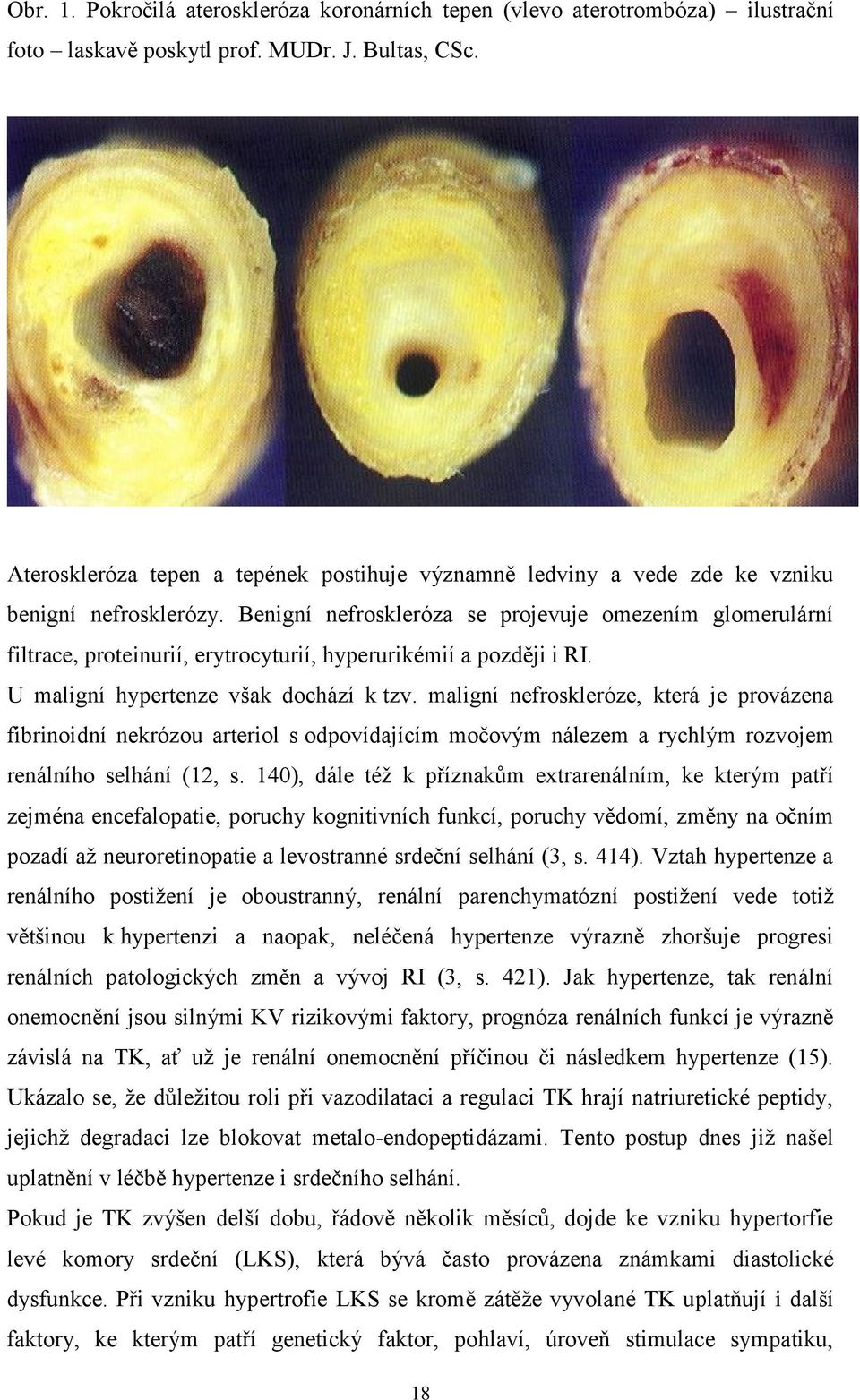 Benigní nefroskleróza se projevuje omezením glomerulární filtrace, proteinurií, erytrocyturií, hyperurikémií a později i RI. U maligní hypertenze však dochází k tzv.