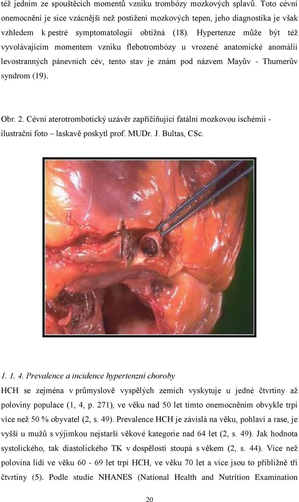 Hypertenze může být též vyvolávajícím momentem vzniku flebotrombózy u vrozené anatomické anomálii levostranných pánevních cév, tento stav je znám pod názvem Mayův - Thurnerův syndrom (19). Obr. 2.