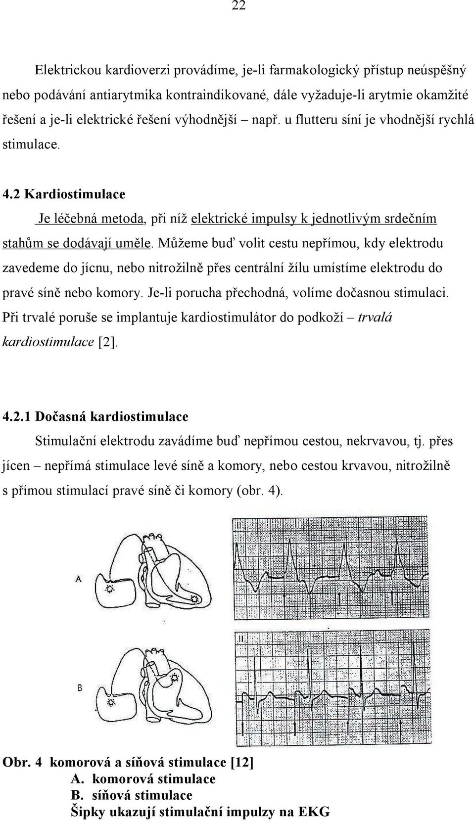 Můžeme buď volit cestu nepřímou, kdy elektrodu zavedeme do jícnu, nebo nitrožilně přes centrální žílu umístíme elektrodu do pravé síně nebo komory. Je-li porucha přechodná, volíme dočasnou stimulaci.