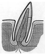 Schematický obrázek vzniku ptačího pera pulpa