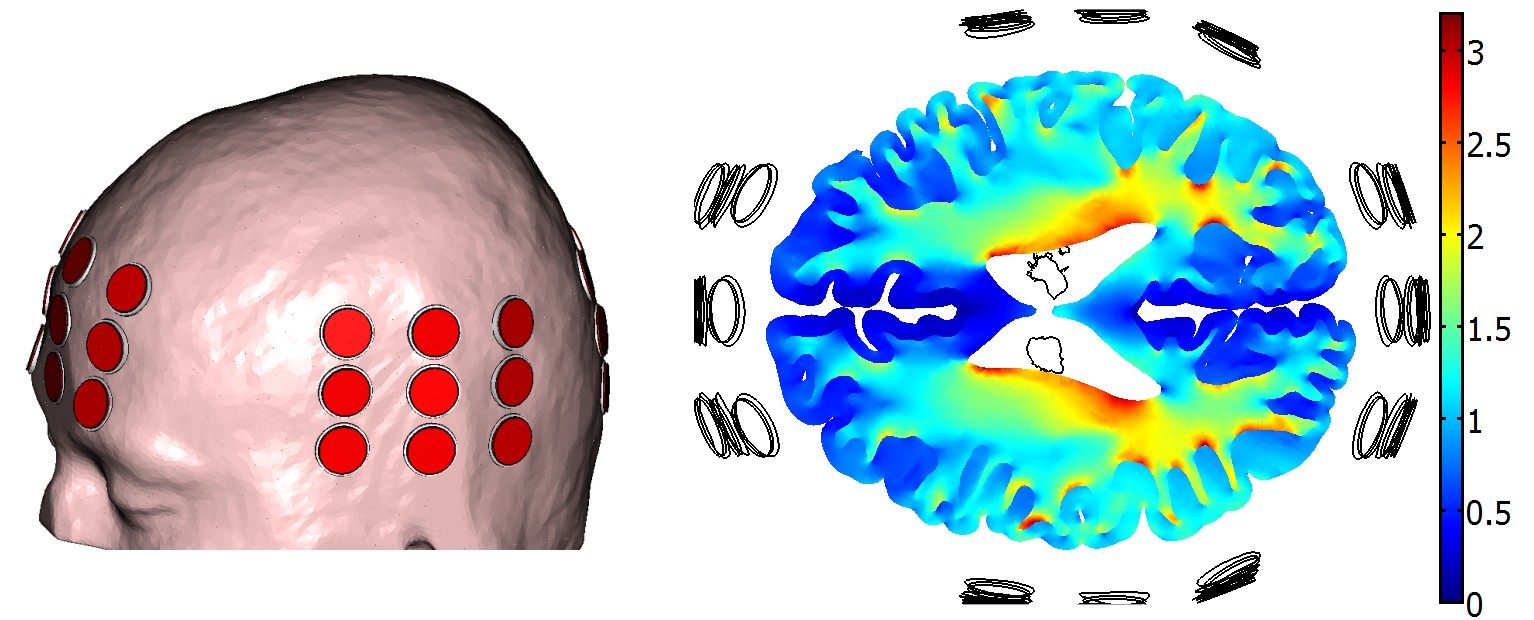 Field distribution in the brain Modeling the Electric Field Distribution within