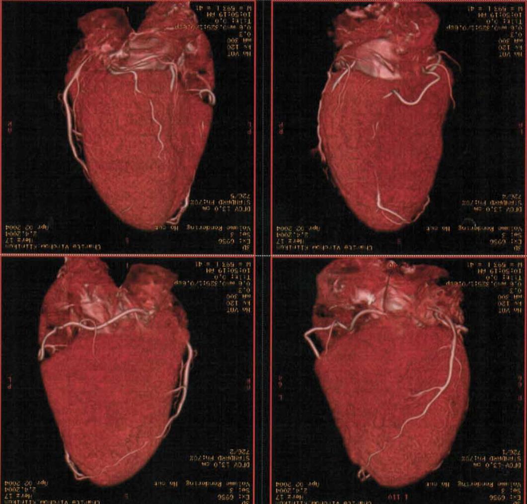 postmortem 3-D CT-koronární