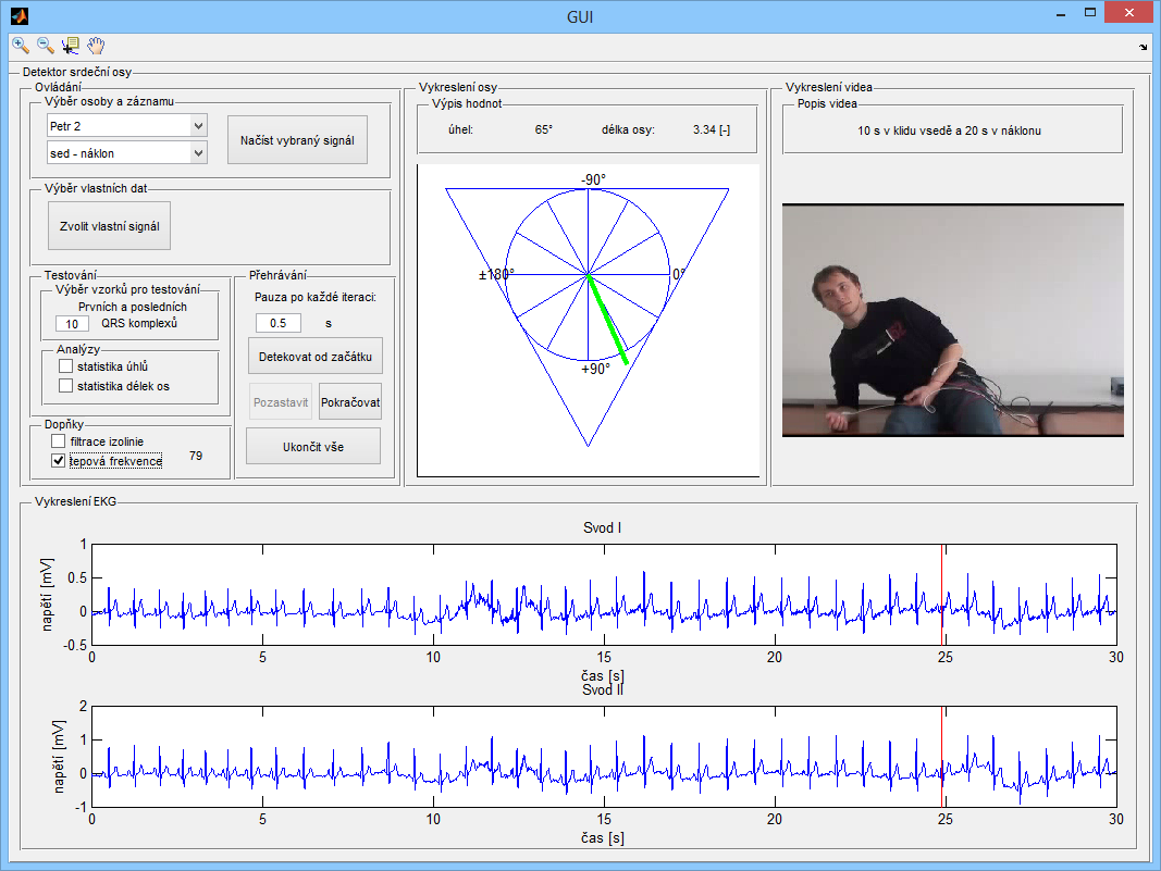 5 APLIKACE 5.1 GUI - Detektor srdeční osy V Guide programovacího prostředí Matlab byl vytvořen program GUI představující detektor srdeční osy. Spouštění probíhá přes otevřený soubor GUI.