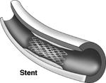 STENT