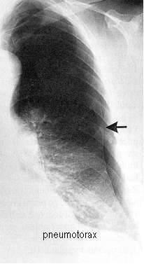 Ukázky patologií plic - pneumotorax vzduch v pleurální dutině etiologicky traumatický, iatrogenní, spont.