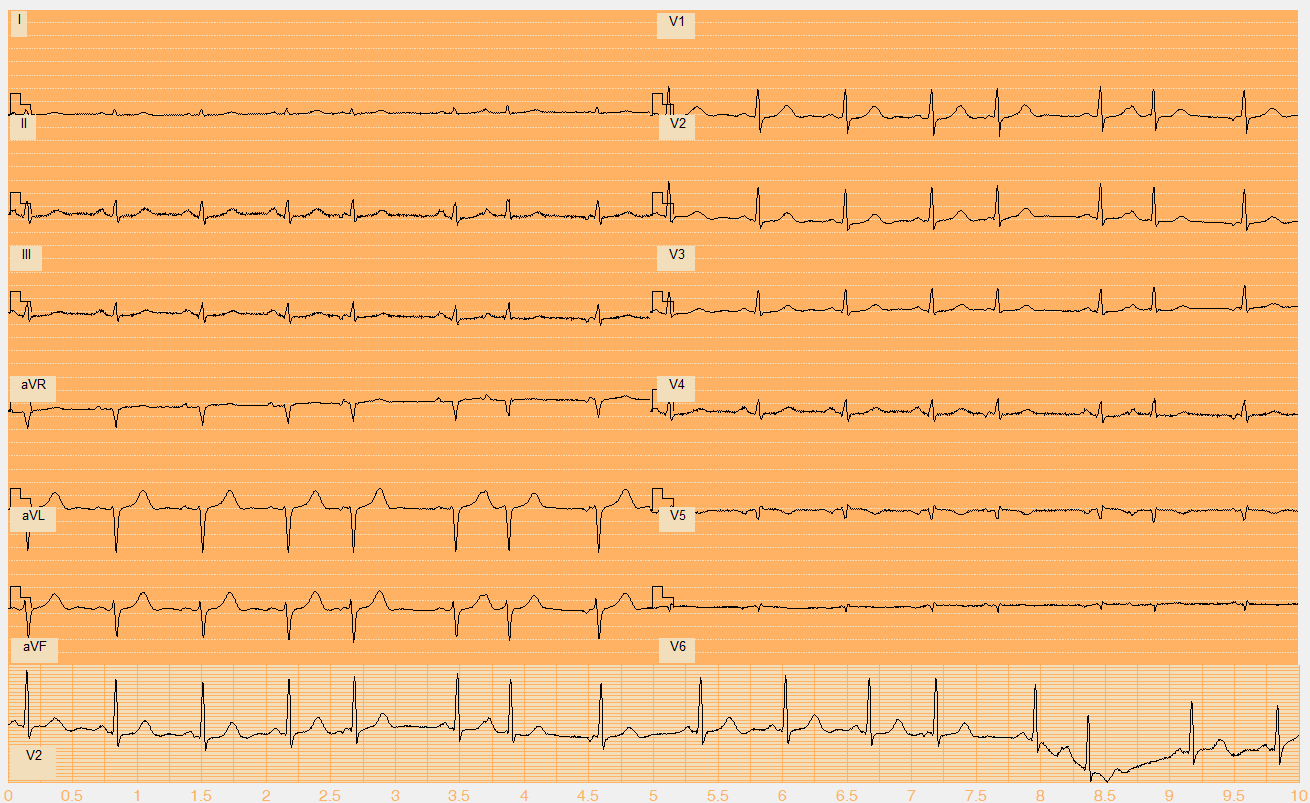 PŘÍLOHY Příloha 1: Popsané EKG signály se zobrazením ve vytvořené aplikaci Číslo EKG záznamu W006.mat Akce nepravidelná Rytmus sinus + SVES polymorfní, nodální (I. typ 5., 8., 12., II. typ 7., 14.