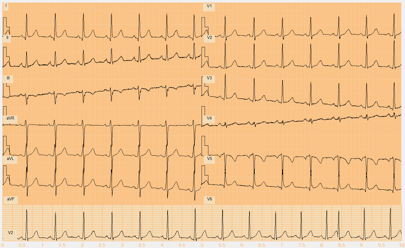 Číslo EKG záznamu W011.mat Akce pravidelná Rytmus sinus + 1 SVES (13.