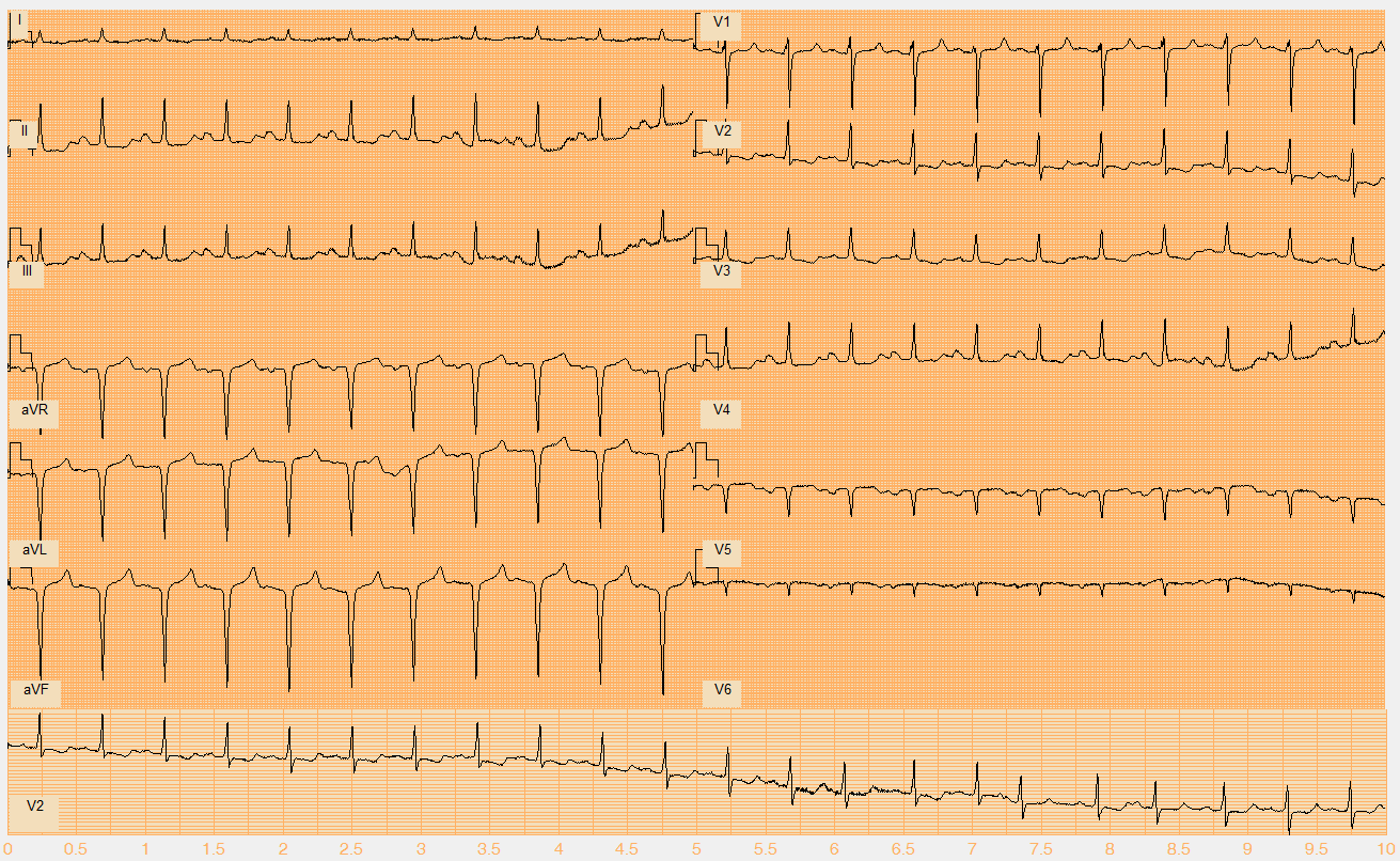 Číslo EKG záznamu W020.mat Akce nepravidelná Rytmus sinus + SVES (14., 17.