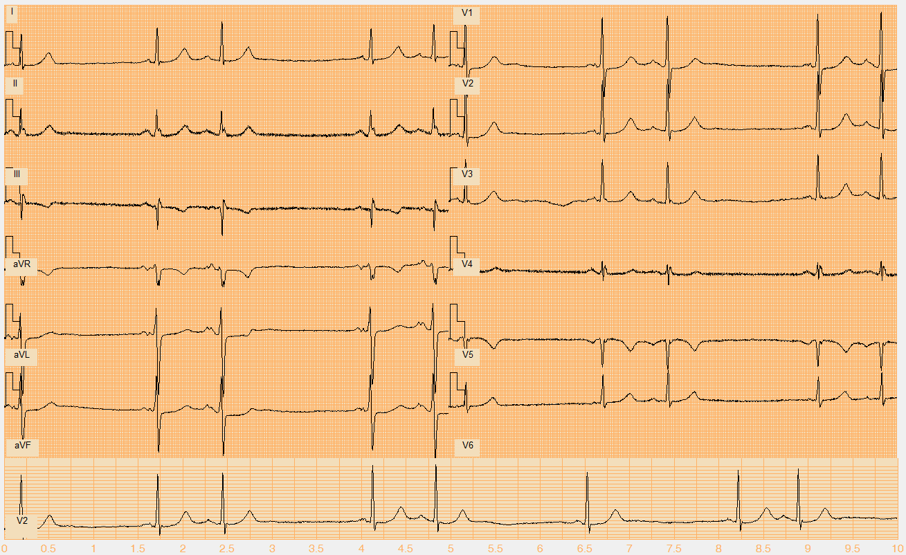 Číslo EKG záznamu W023.mat Akce nepravidelná Rytmus SA blok II. stupně, AV blok 2. stupně, typ Möbitz I. (I. typ 1., 2., 4., 6., 7. beat, II. typ 3., 5., 8.