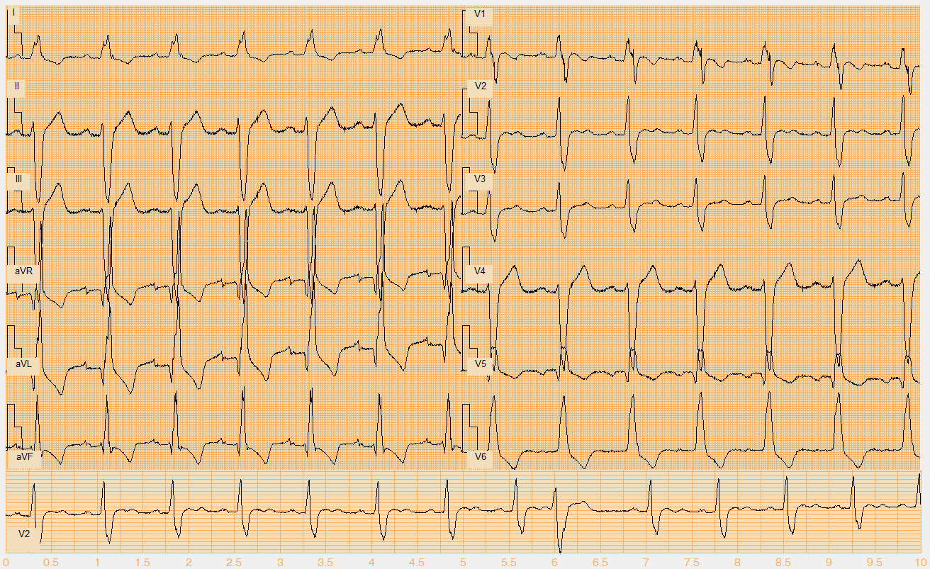 Číslo EKG záznamu W026.mat Akce pravidelná Rytmus sinus, 1 KES (9.