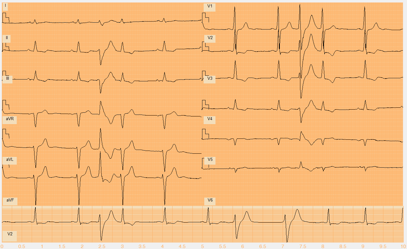 Číslo EKG záznamu W028.mat Akce nepravidelná Rytmus sinus + monomorfní KES (3., 7. beat), splynulý stah (8.