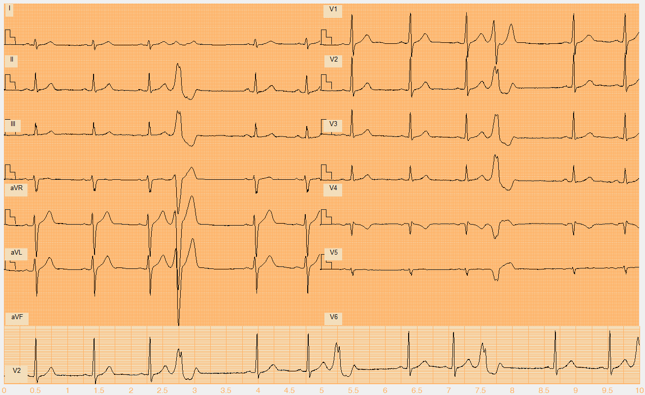 Číslo EKG záznamu W034.mat Akce nepravidelná Rytmus sinus + monomorfní KES (4., 7., 10.