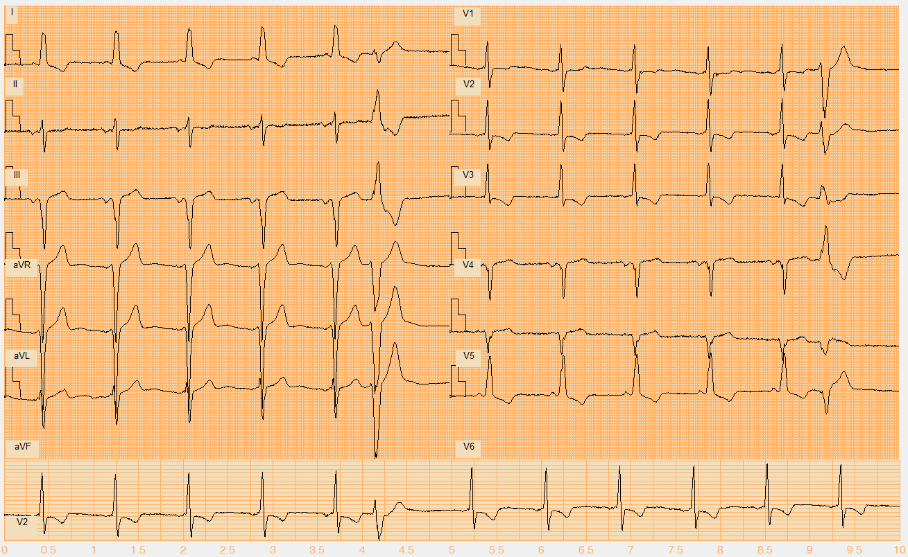 Číslo EKG záznamu W040.mat Akce pravidelná Rytmus junkční, 1 KES (6.