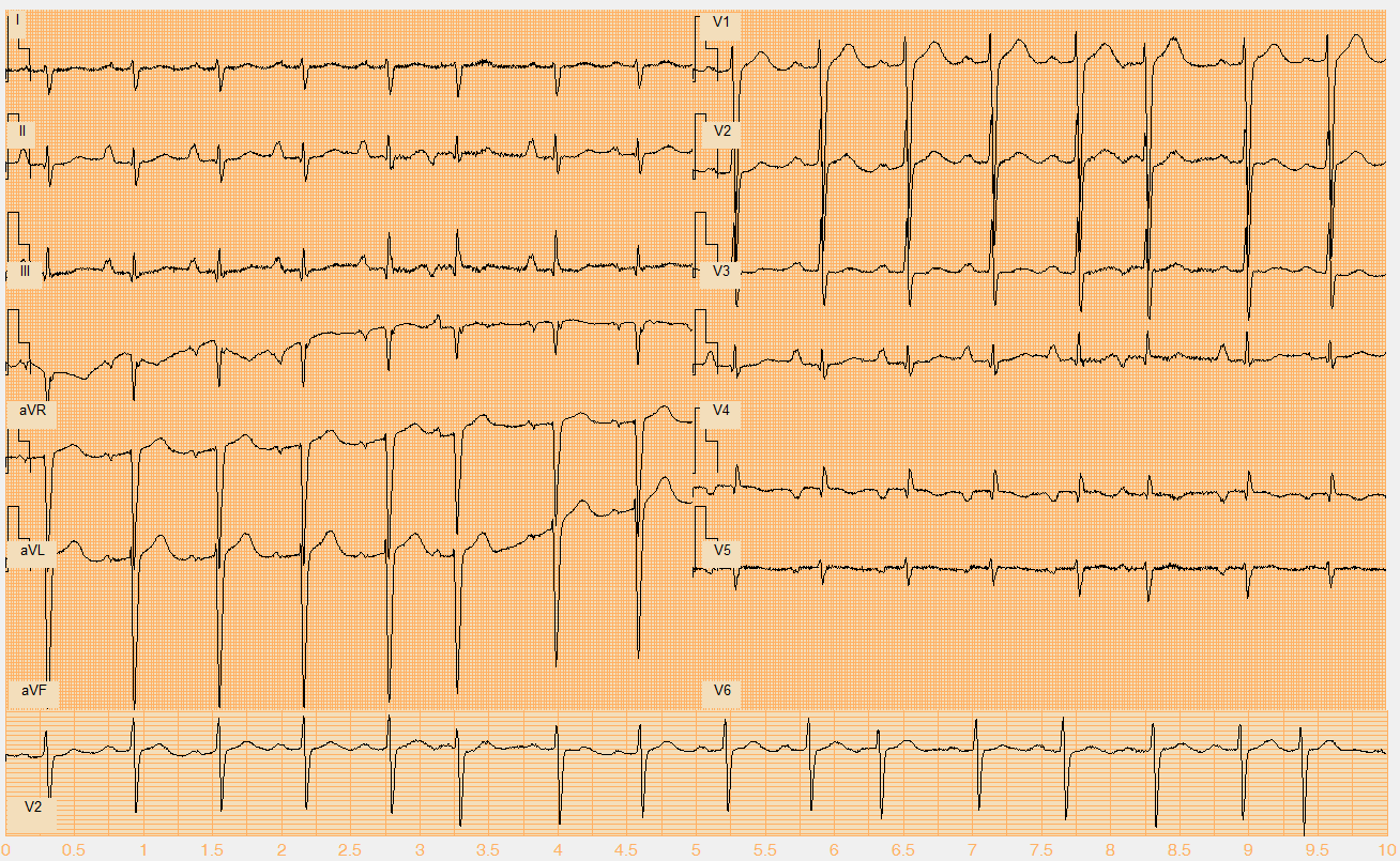 Číslo EKG záznamu W047.mat Akce nepravidelná Rytmus sinus + junkční polymorfní extrasystoly (I. typ 6., 11. beat, II. typ 16.