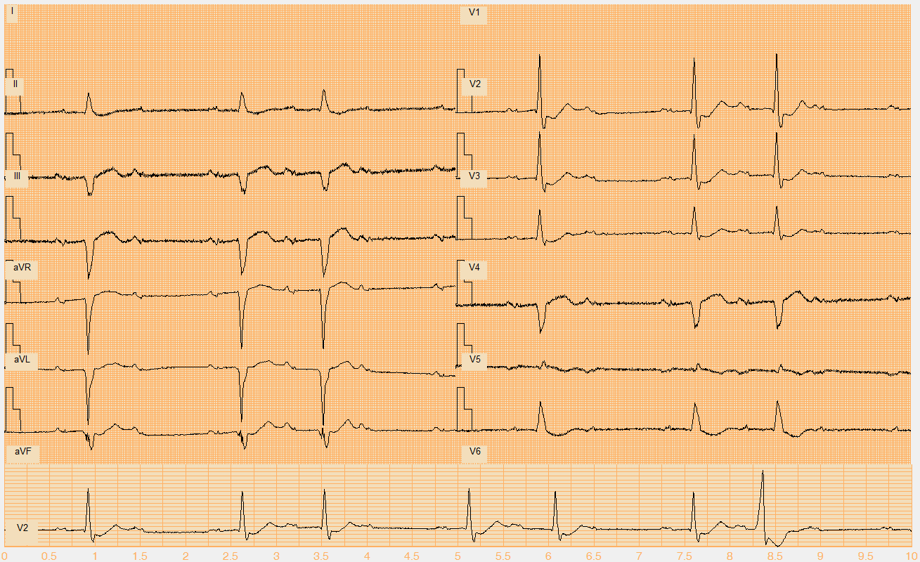 Číslo EKG záznamu W054.mat Akce nepravidelná Rytmus AV blok Wenckebach 3:2, 1 KES (7.