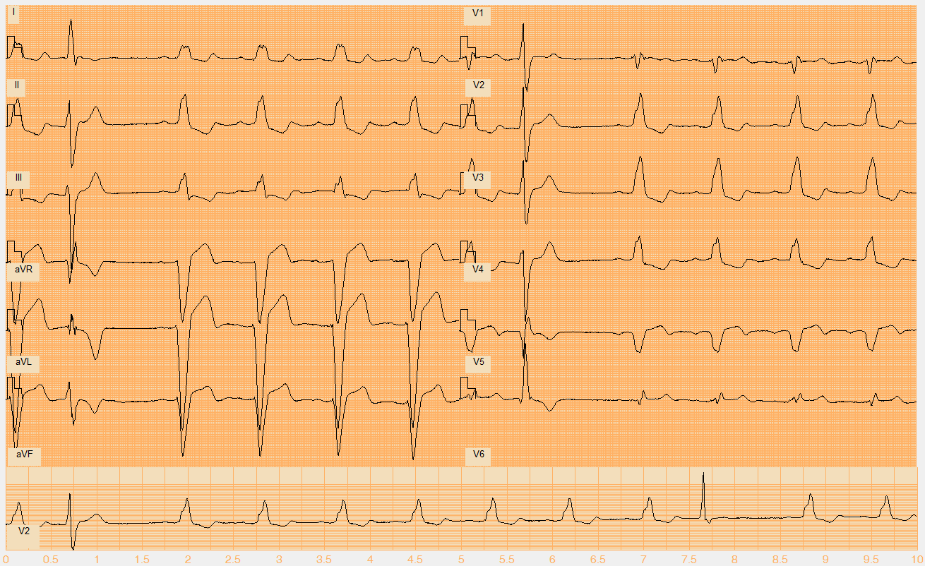 Číslo EKG záznamu W065.mat Akce nepravidelná Rytmus sinus, polymorfní KES (2., 10.