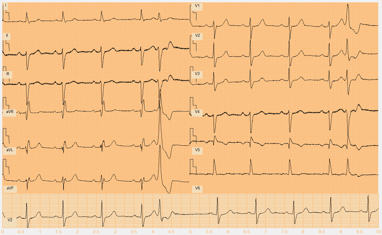 Číslo EKG záznamu W074.mat Akce pravidelná Rytmus sinus, 1 KES (5. beat), AV blok 1.