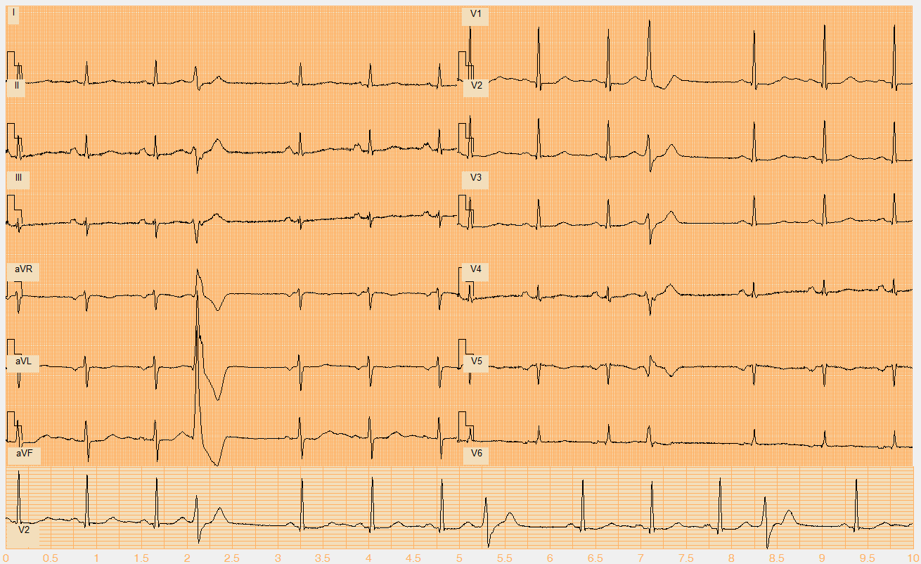 Číslo EKG záznamu W075.mat Akce nepravidelná Rytmus sinus, monomorfní KES (4., 8, 12.