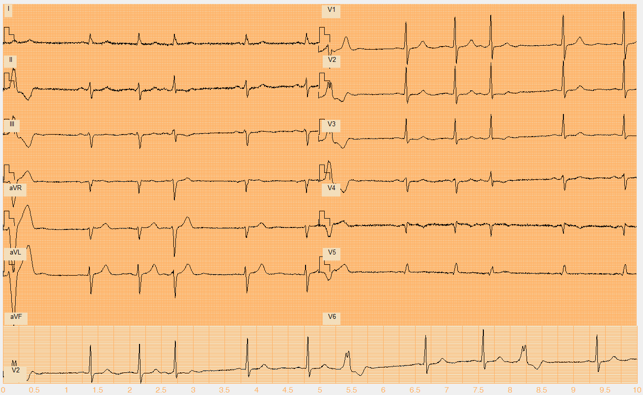 Číslo EKG záznamu W103.mat Akce nepravidelná Rytmus sinus + sporadická SVES (4. beat) + monomorfní KES (1., 7., 10.