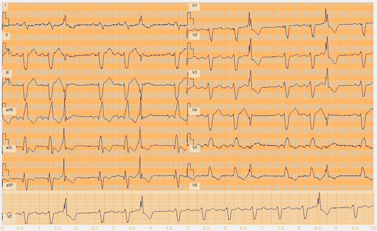 Číslo EKG záznamu W105.mat Akce nepravidelná Rytmus sinus + monomorfní KES (3., 6., 13.