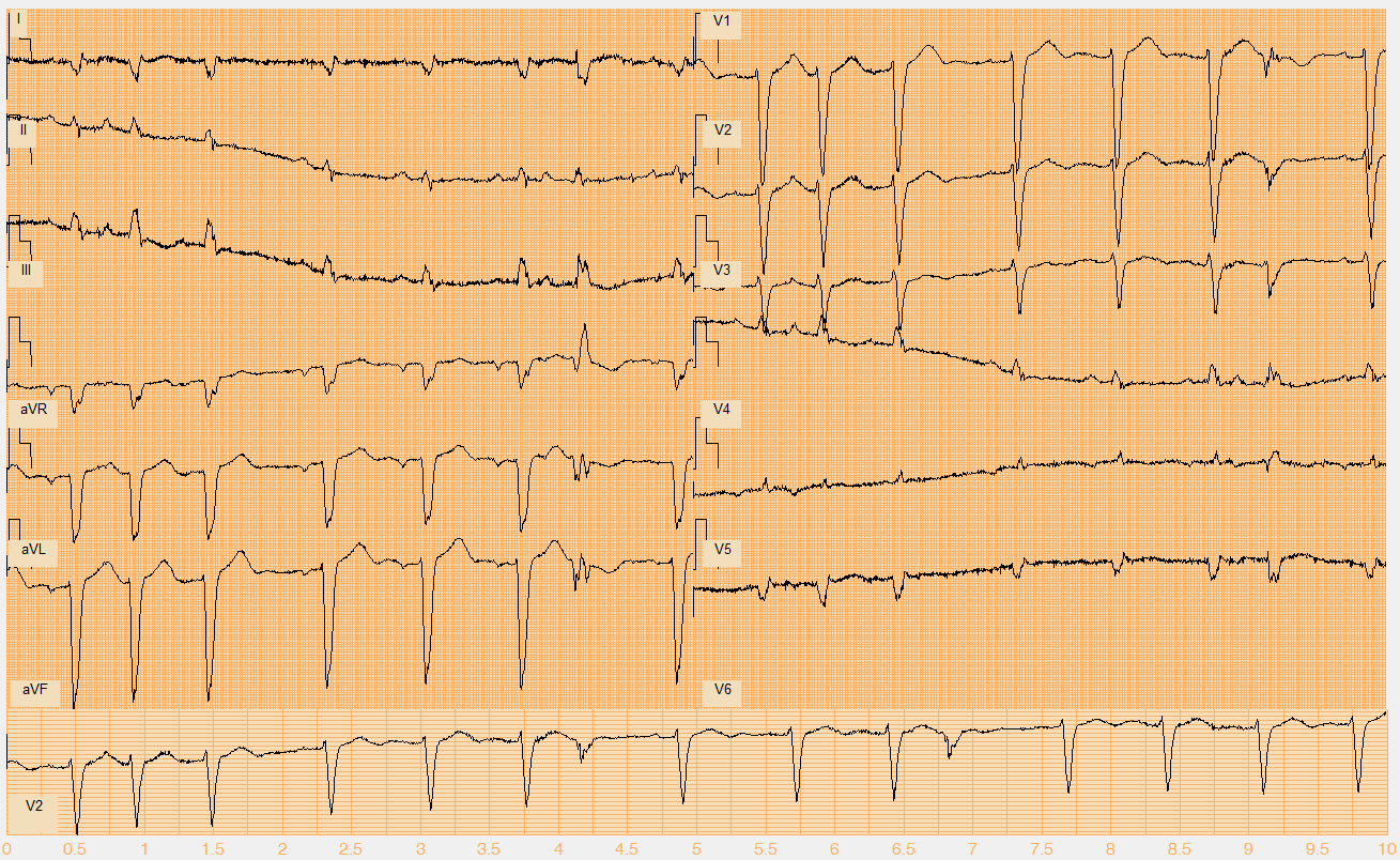 Číslo EKG záznamu W109.mat Akce nepravidelná Rytmus sinus + monomorfní KES (7., 11. beat) + pravděpodobná junkční SVES (2.