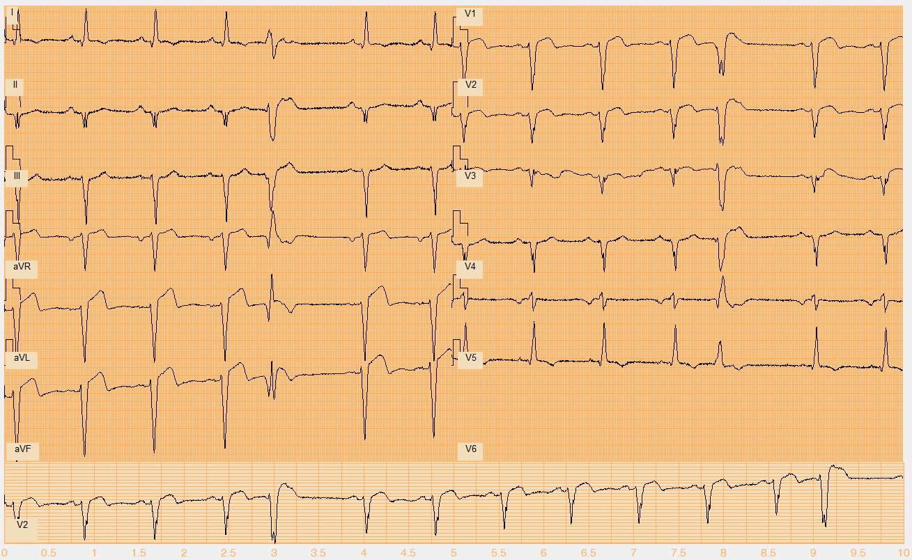 Číslo EKG záznamu W112.mat Akce nepravidelná Rytmus sinus, monomorfní KES (5., 13.