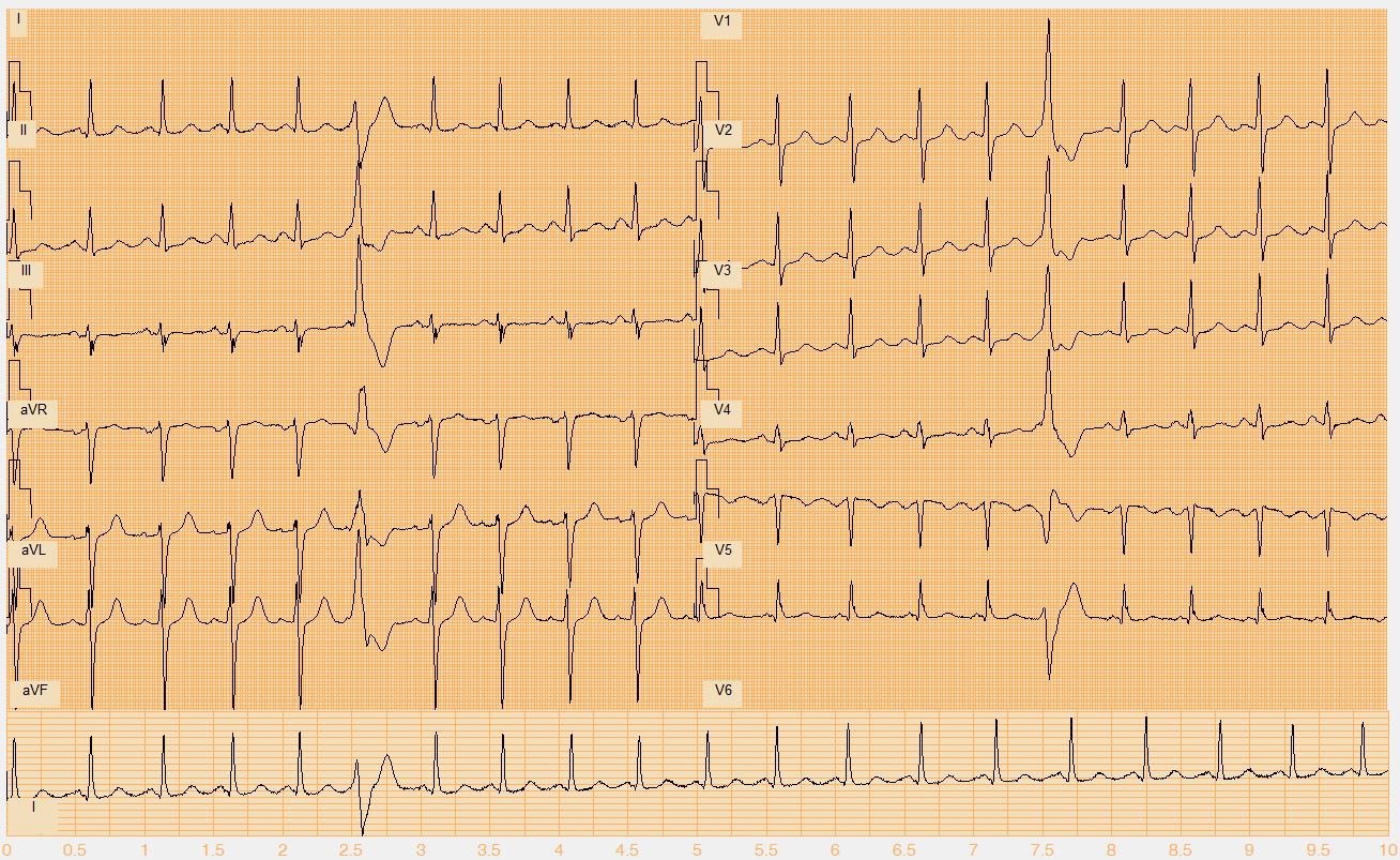 Číslo EKG záznamu W115.mat Akce pravidelná Rytmus sinus, KES (6.