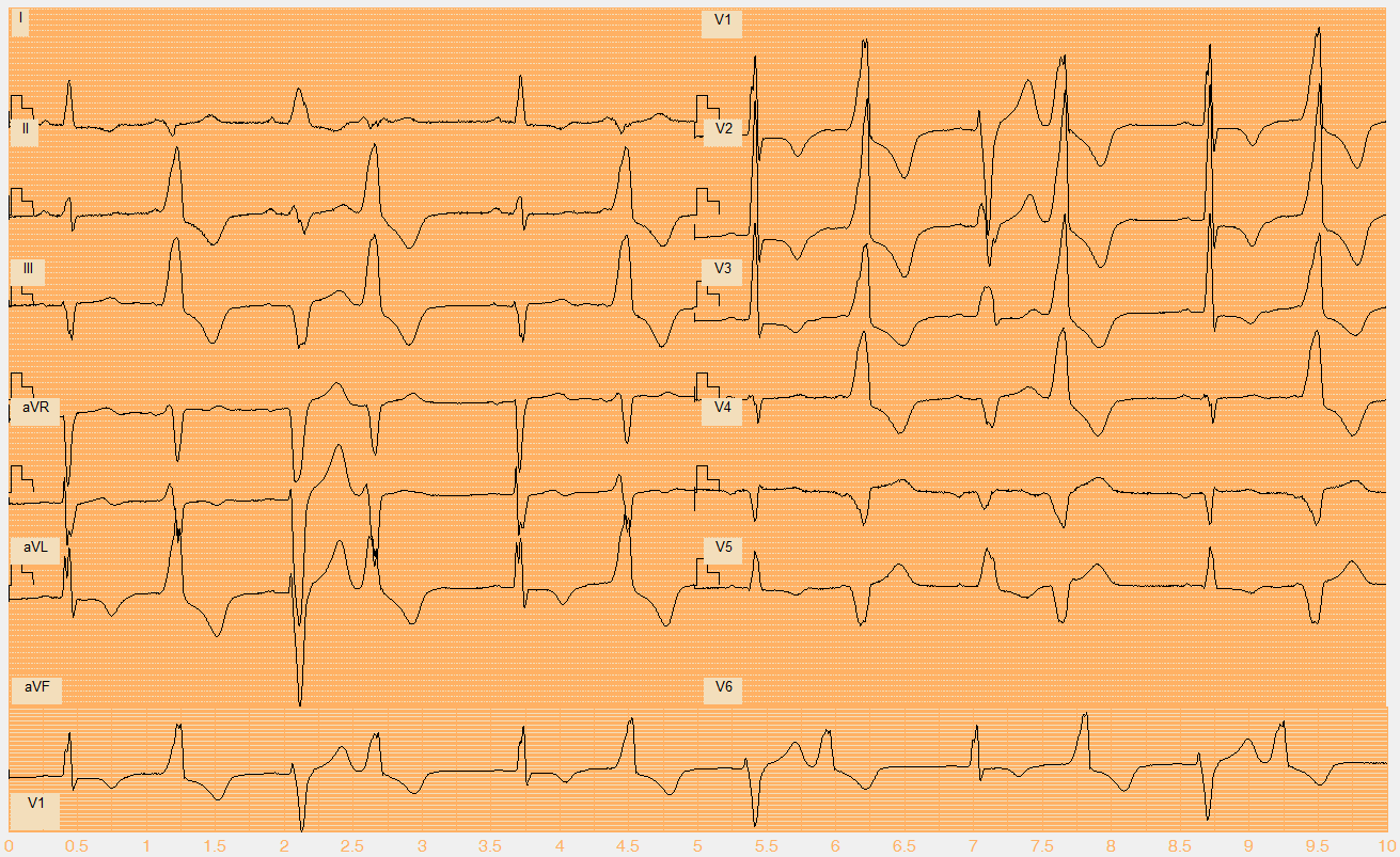 Číslo EKG záznamu W117.mat Akce nepravidelná Rytmus sinus (1., 5., 9. beat), sinus tvar BLRT + LPH (3., 7., 11. beat) + polymorfní KES I. typ (2., 6., 10. beat), II. typ (4., 8., 12.