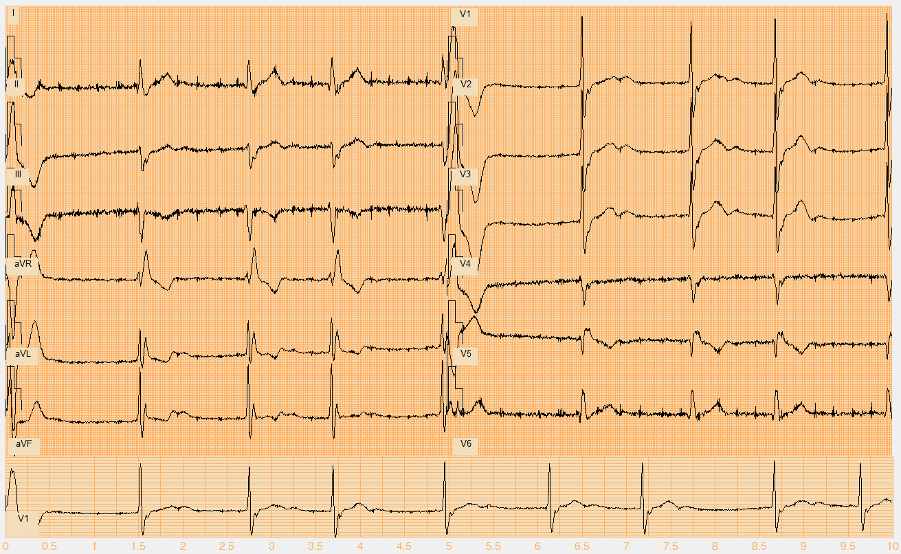 Číslo EKG záznamu W120.mat Akce nepravidelná Rytmus možná, ale nepravděpodobná nízkovlnná FIS, bradykardie, KES (1.