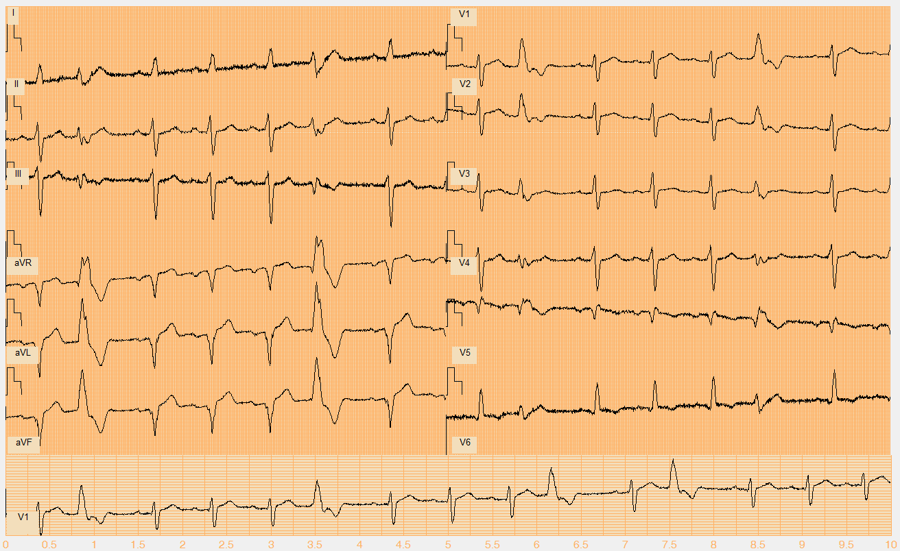 Číslo EKG záznamu W122.mat Akce nepravidelná Rytmus sinus + monomorfní KES (2., 6., 10., 12.