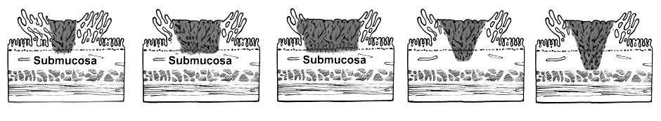 Kikuchi Levels and LN involvement T1 sm1a Invasive depth <1/3 through submucosa, usually <0.3mm. Invades <1/3 of width of adenoma T1 sm1b Invasive depth <1/3 through submucosa, usually <0.3mm. Invades >1/3 & <2/3 of width of adenoma T1 sm1c Invasive depth <1/3 through submucosa, usually <0.