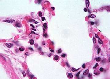 nákazy Pcp: alveoly vyplněné