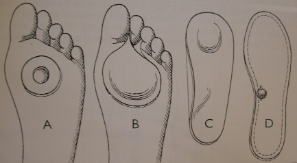 odlitku a nebo z tvarovatelných materiálů, a to na každou nohu zvlášť, protože stupeň deformace je často na obou nohách různý. Velmi vhodná je obuv s pevnou vložkou, která neklouže.