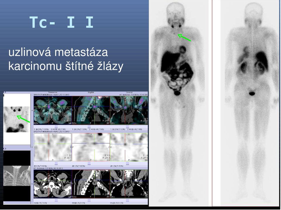 metastáza