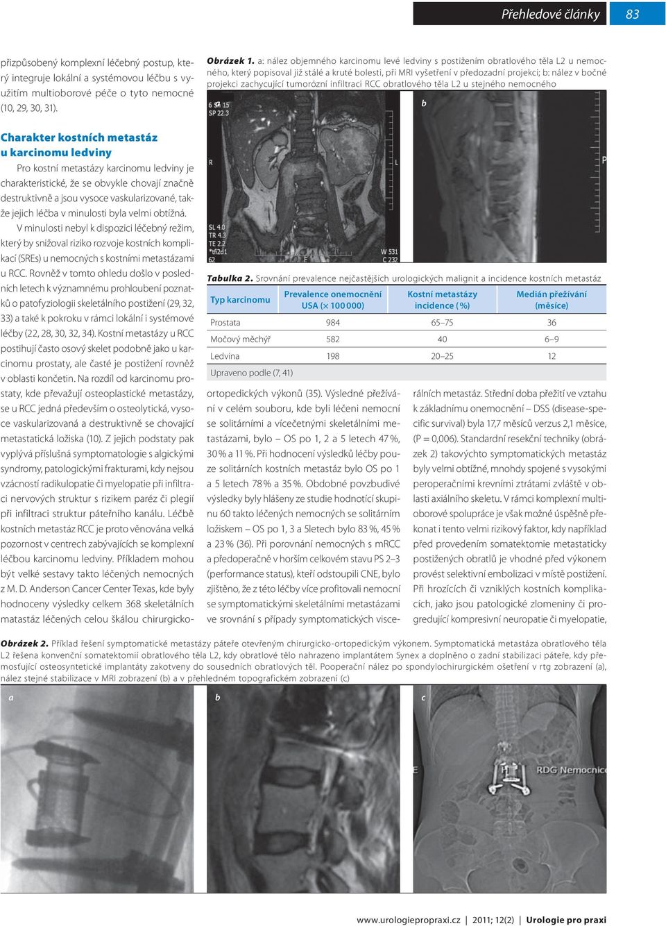 zachycující tumorózní infiltraci RCC obratlového těla L2 u stejného nemocného a b Tabulka 2.