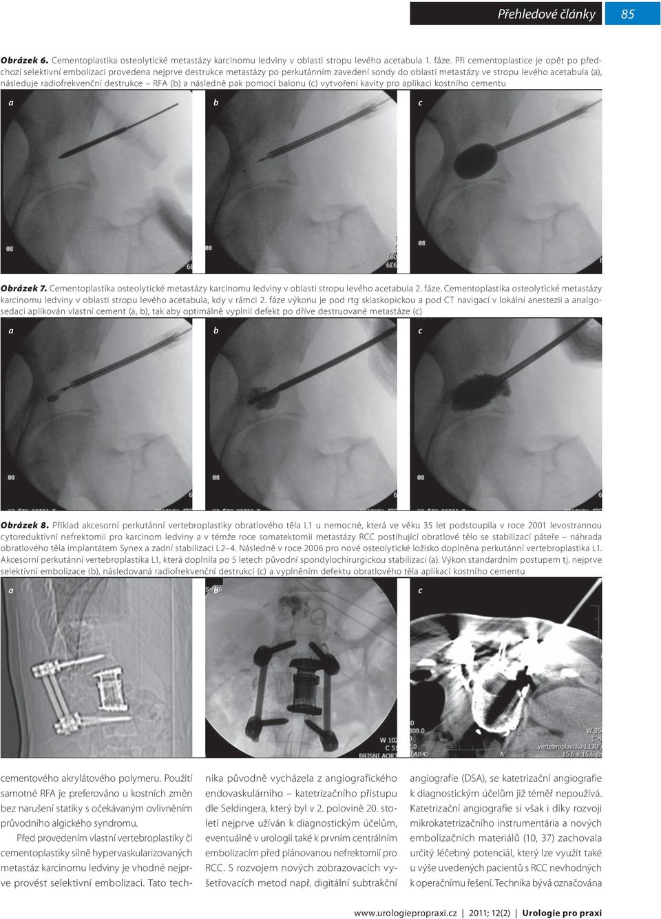 radiofrekvenční destrukce RFA (b) a následně pak pomocí balonu (c) vytvoření kavity pro aplikaci kostního cementu Obrázek 7.
