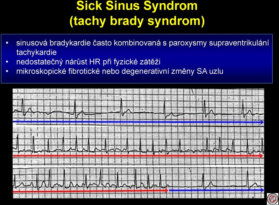 supraventrikulání tachykardie nedostatečný nárůst HR