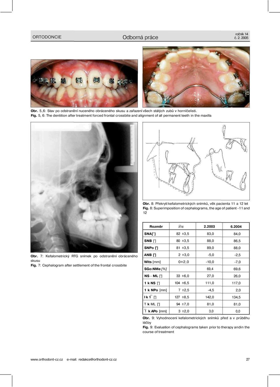 8: Superimposition of cephalograms, the age of patient -11 and 12 Rozměr x±s 2.2003 6.2004 SNA[ ] 82 ±3,5 83,0 84,0 SNB [ ] 80 ±3,5 88,0 86,5 SNPo [ ] 81 ±3,5 89,0 88,0 Obr.