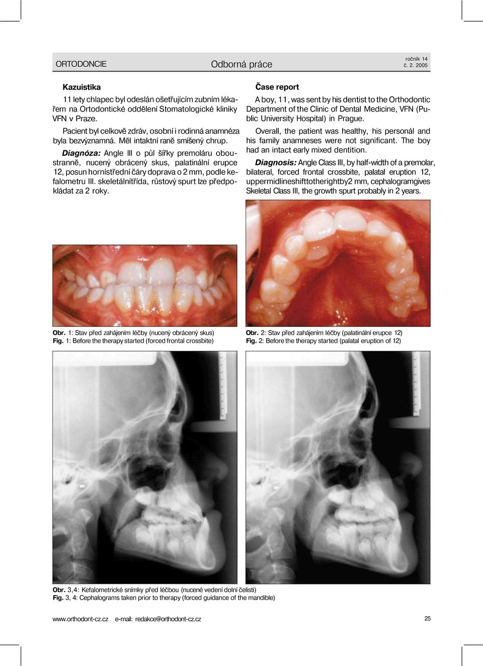 Diagnóza: Angle III o půl šířky premoláru oboustranně, nucený obrácený skus, palatinální erupce 12, posun hornístřední čáry doprava o 2 mm, podle kefalometru III.