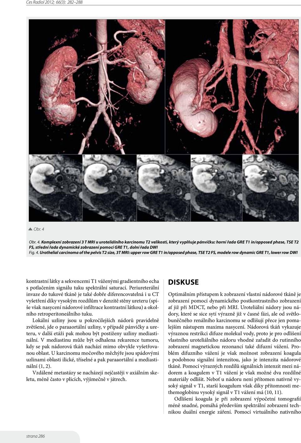 Komplexní zobrazení 3 T MRI u uroteliálního karcinomu T2 velikosti, který vyplňuje pánvičku: horní řada GRE T1 in/opposed phase, TSE T2 FS, střední řada dynamické zobrazení pomocí GRE T1, dolní řada