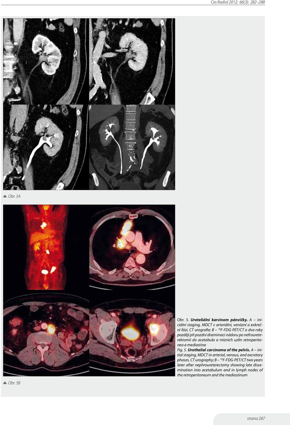 po nefroureterektomii do acetabula a mízních uzlin retroperitonea a mediastina Fig. 5. Urothelial carcinoma of the pelvis.