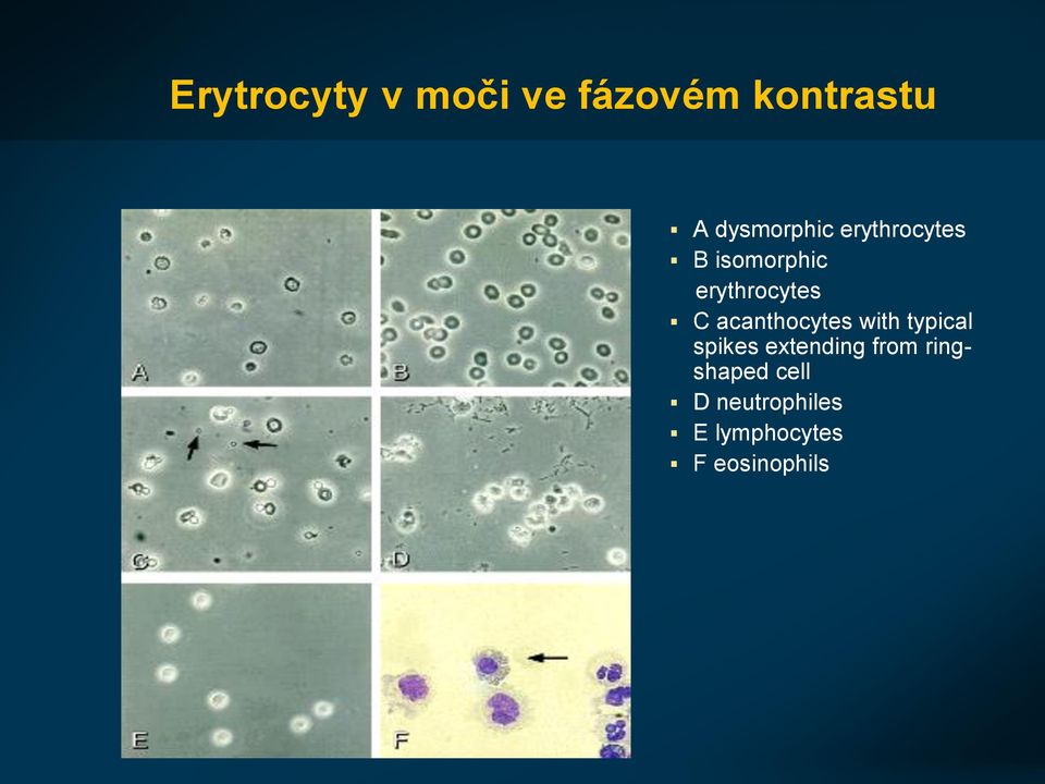 C acanthocytes with typical spikes extending from