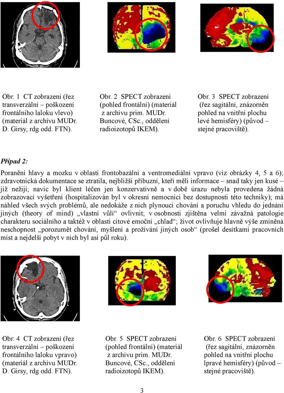 Případ 2: Poranění hlavy a mozku v oblasti frontobazální a ventromediální vpravo (viz obrázky 4, 5 a 6); zdravotnická dokumentace se ztratila, nejbližší příbuzní, kteří měli informace snad taky jen