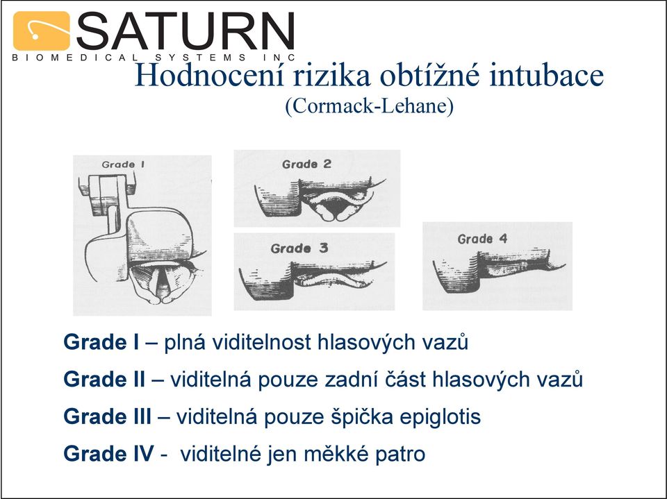 viditelná pouze zadní část hlasových vazů Grade III