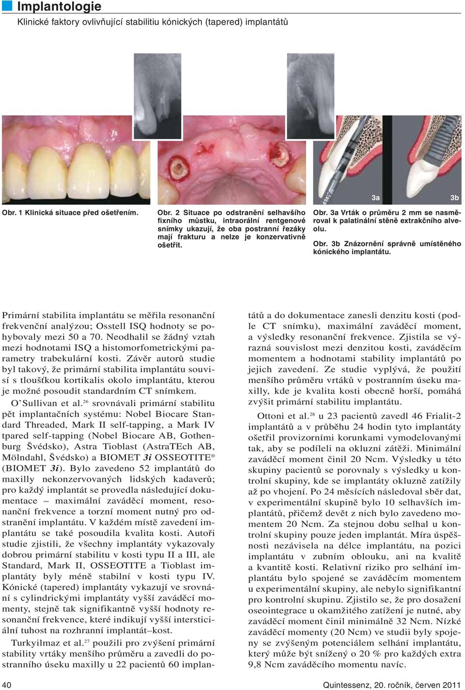 40 Primární stabilita implantátu se měřila resonanční frekvenční analýzou; Osstell ISQ hodnoty se pohybovaly mezi 50 a 70.