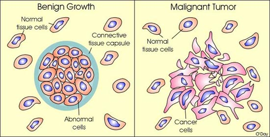 Maligní buňky Maligně zvrhlé buňky ztrácí většinu vlastností buněk, od kterých jsou odvozeny. Vypadají spíš jako nezralé a špatně diferencované buňky. Mají různý tvar a velikost (Obr. č. 7).