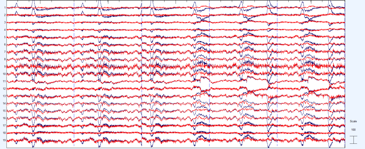 3.4.2 Druhá část Druhá část řešení se zabývá odstraněním artefaktů z EEG signálu pomocí již známých metod. Já si ke své práci vybral metodu analýzy nezávislých komponent.