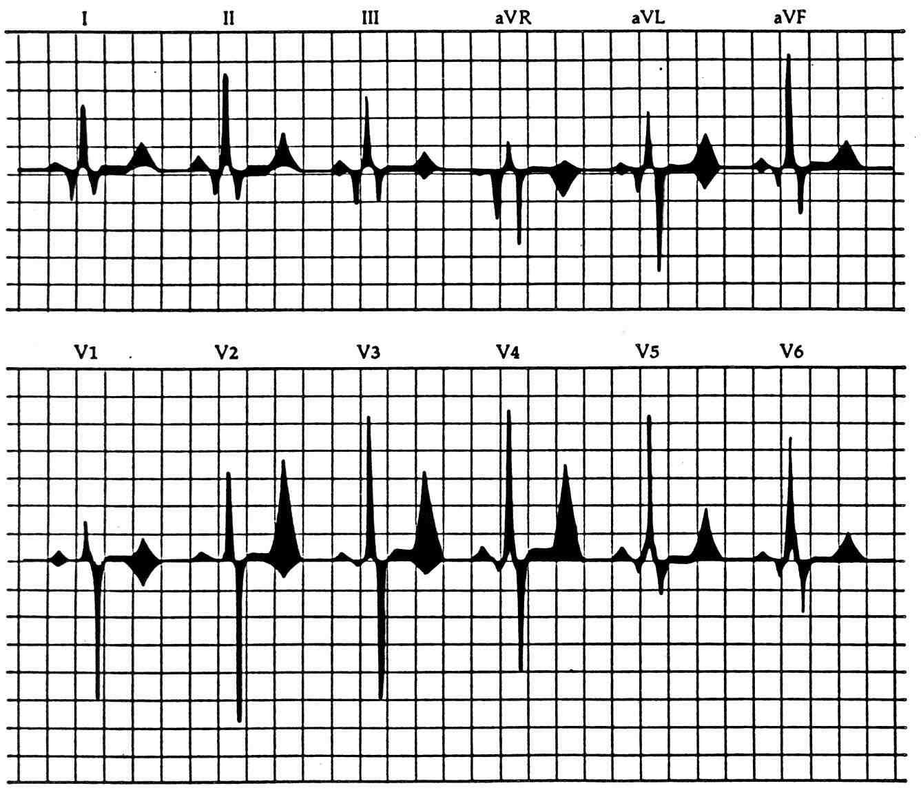 1.2.4. VLASTNOSTI SIGNÁLU EKG V ČASOVÉ OBLASTI Obr.