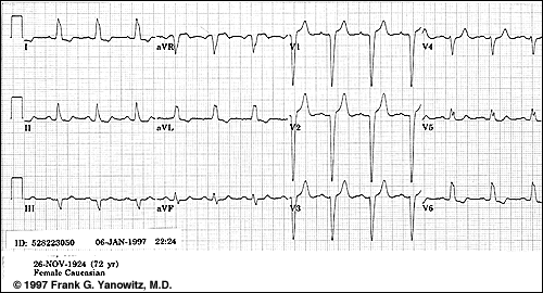 LBBB EKG: široký (> 0,12s) abnormálně tvarovaný komplex QRS, komplex