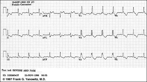 RBBB EKG: široký (> 0,12s) abnormálně tvarovaný komplex QRS,